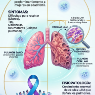 1 JUN: Día de la Concienciación de la Linfangioleiomiomatosis