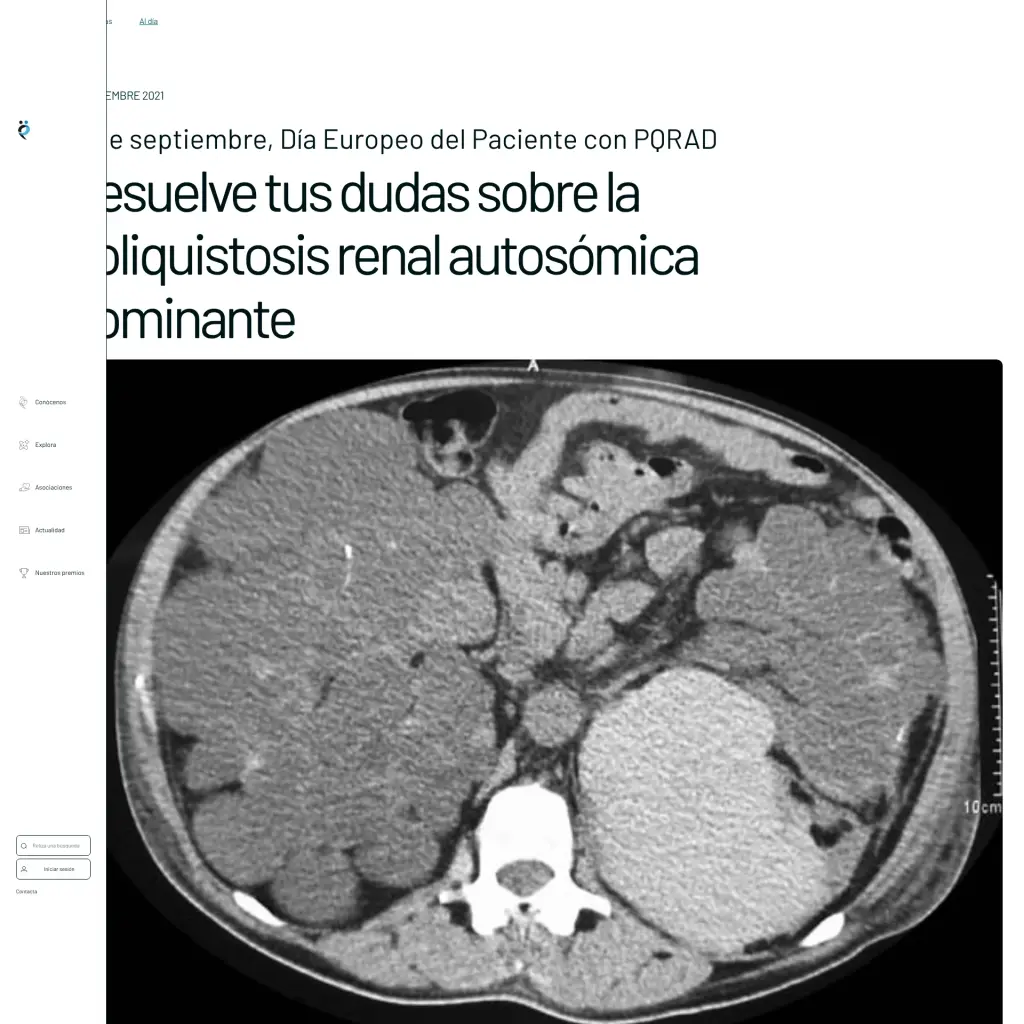 Resuelve tus dudas sobre la poliquistosis renal autosómica dominante
